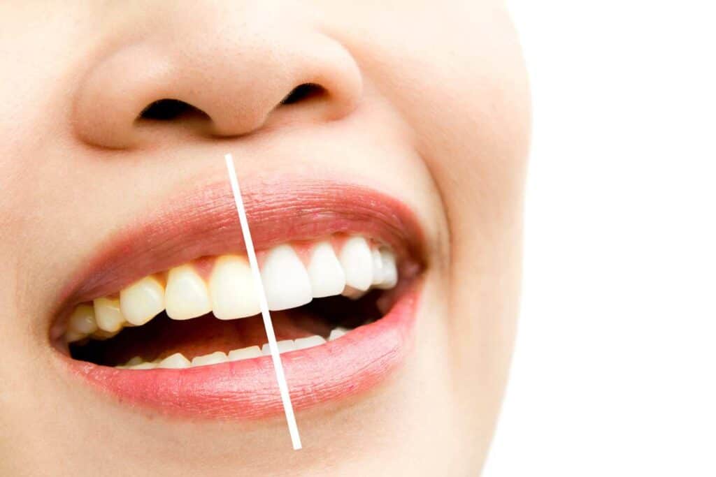 Can I Maintain My New Smile If I&rsquo;m a Coffee or Red Wine Lover Watford